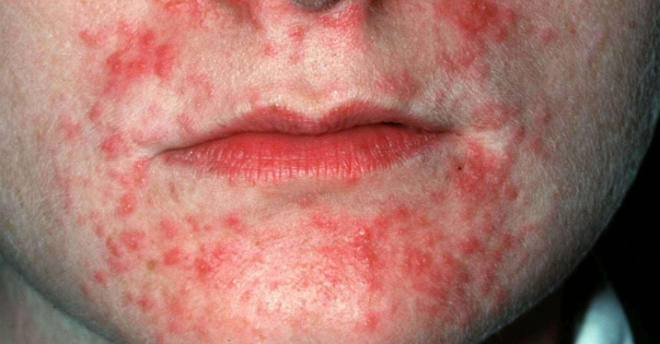 Ruam Kemerahan disekitar wajah? AWAS! KENA DERMATITIS PERIORAL INI CARA MENGATASINYA