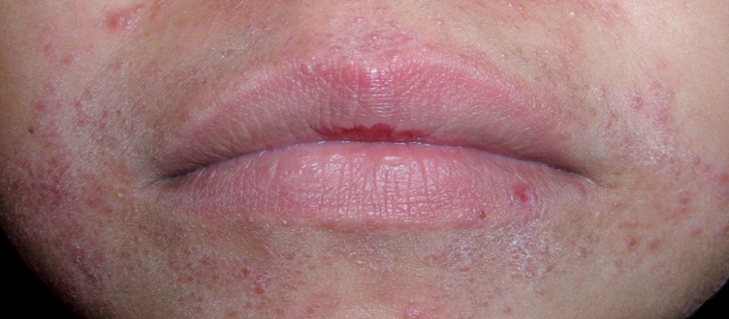 Jangan Asal Makan! Ini Makanan yang Bisa Membuat Dermatitis Perioral Semakin Parah