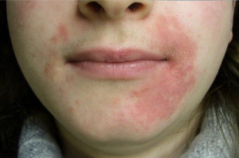 Dermatitis Perioral: Ini Penyebabnya!